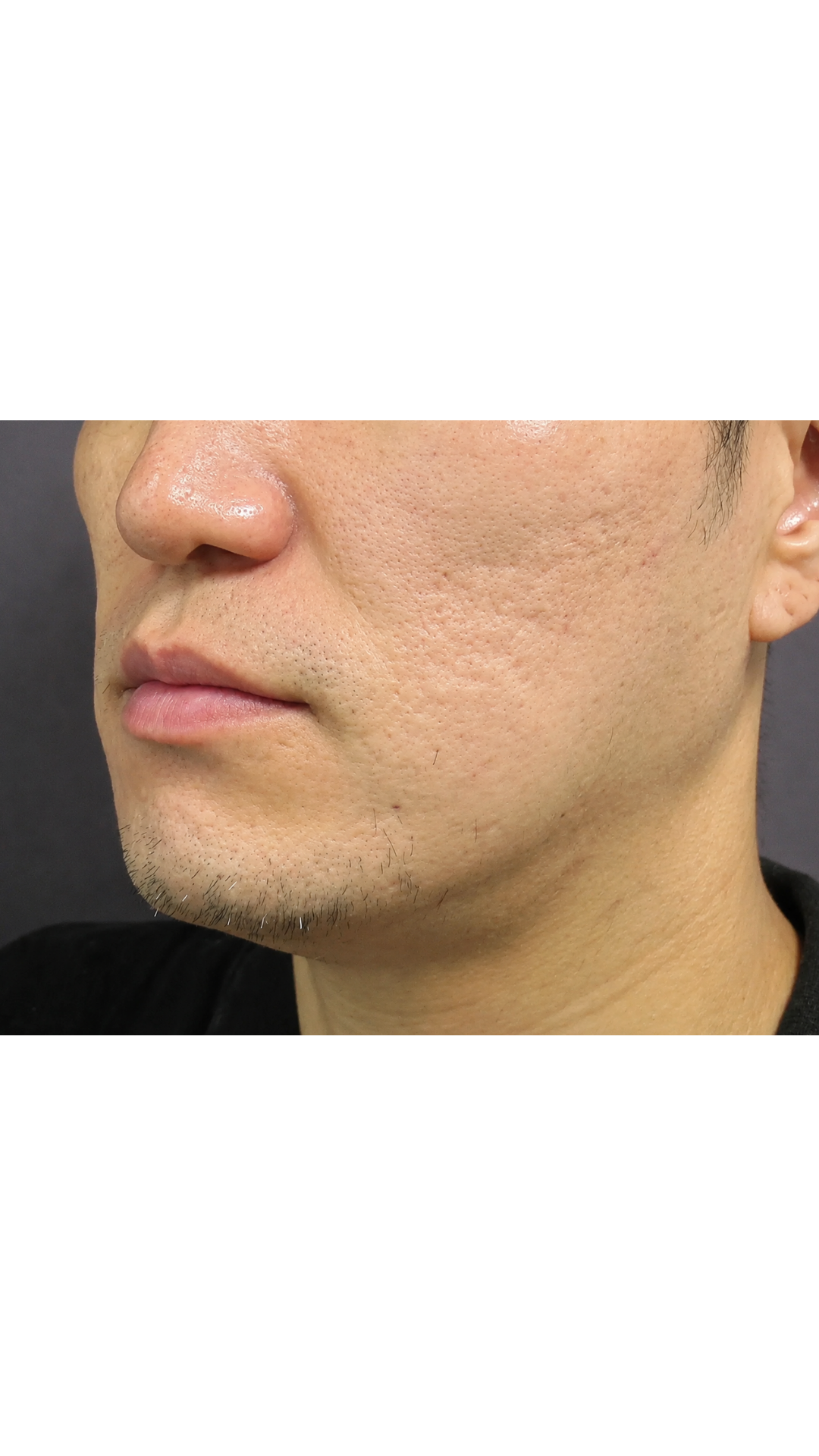 Antes