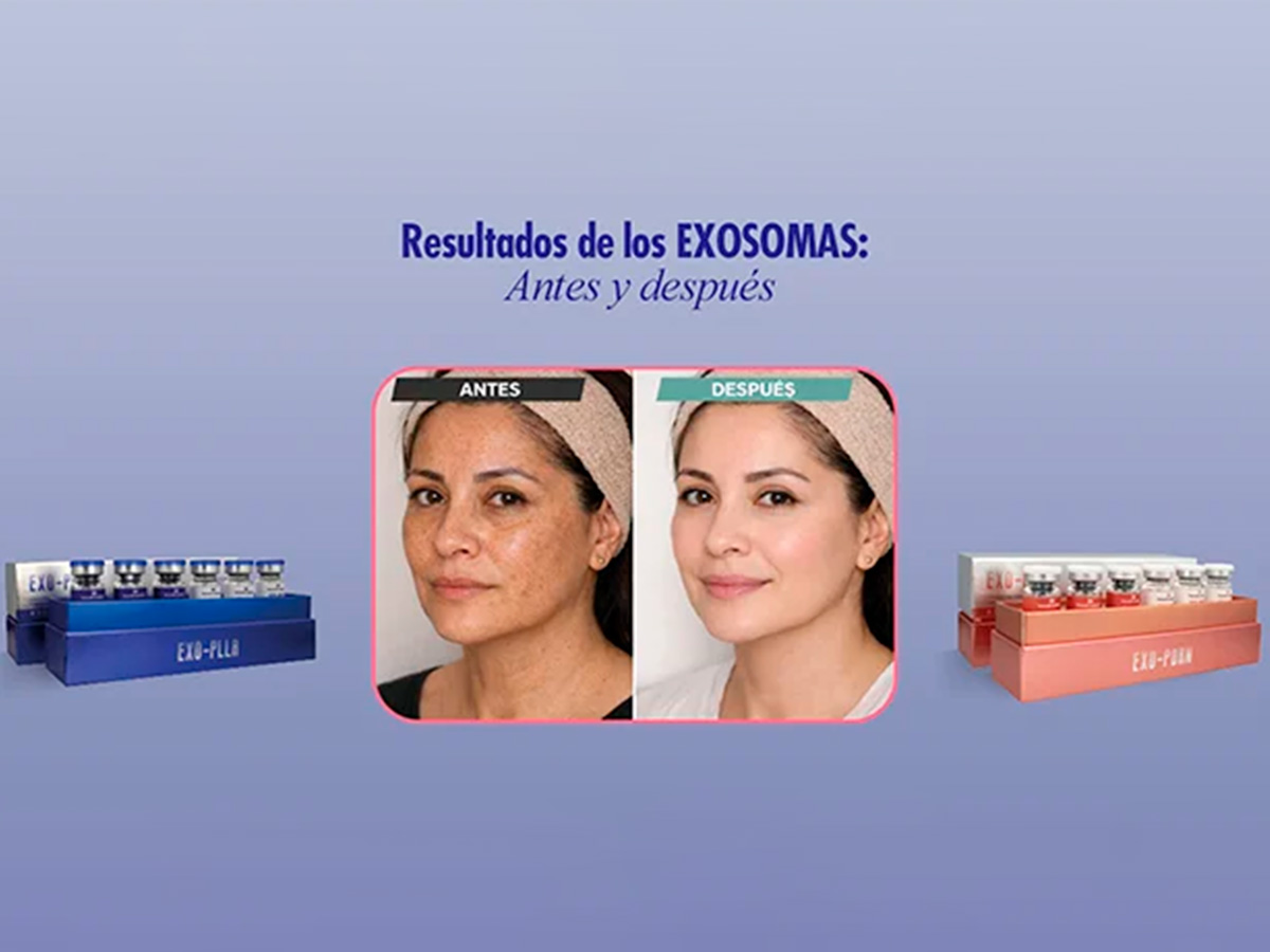 Exosomas antes y después: qué resultados esperar en rostro y cuerpo